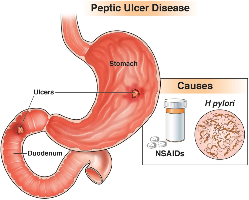 Stomach and intestinal ulcers