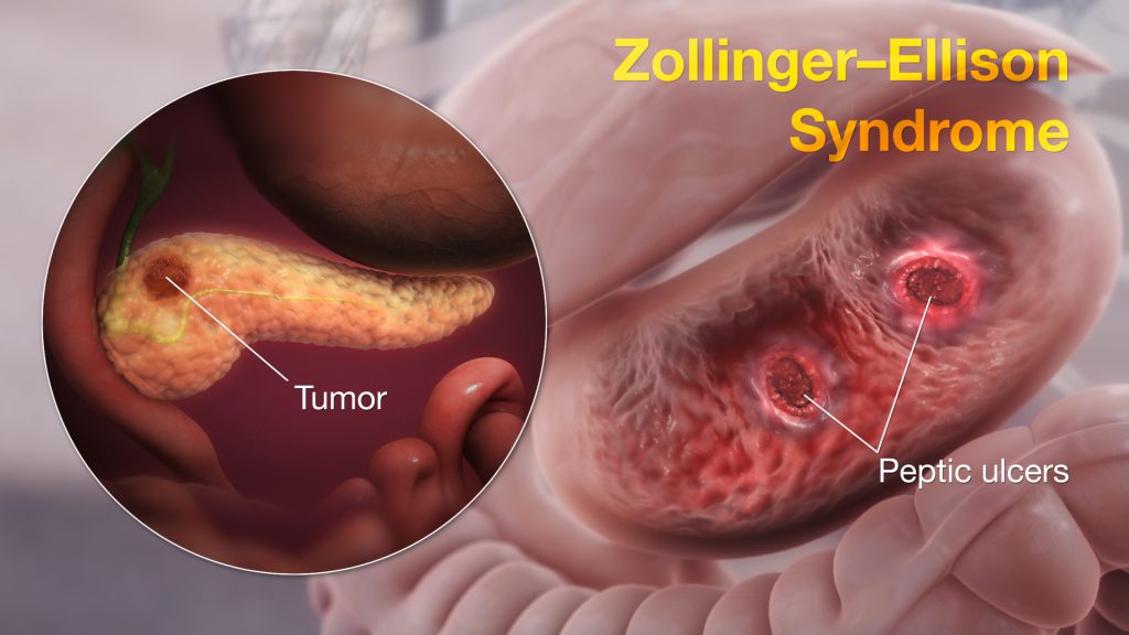 Zollinger-Ellison syndrome