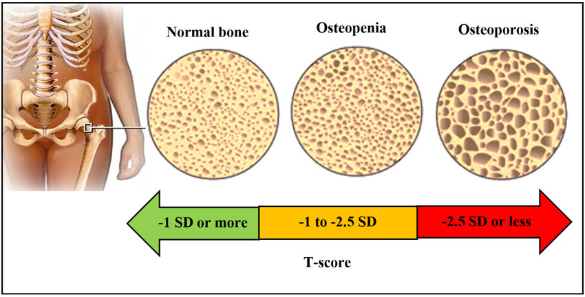 Osteopenia