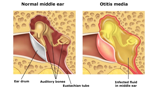 Otitis media