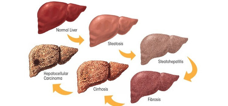 Alcoholic Liver Disease