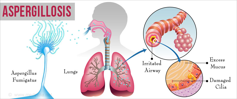 Aspergillosis