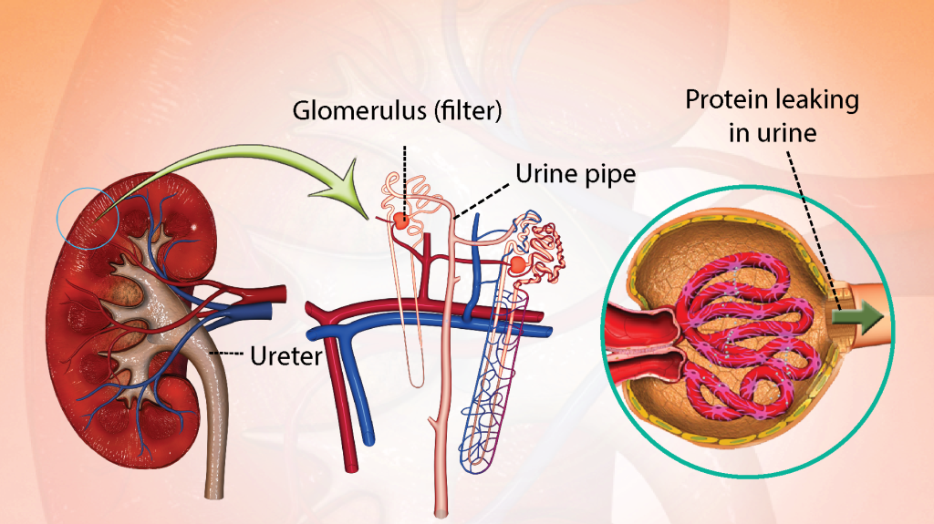 Nephritic syndrome