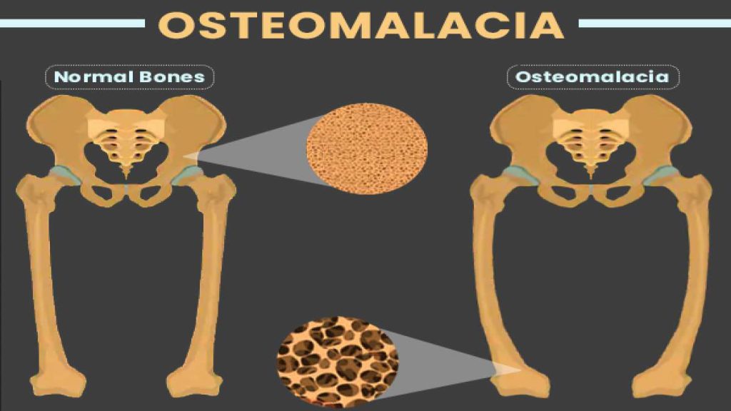 Osteomalacia