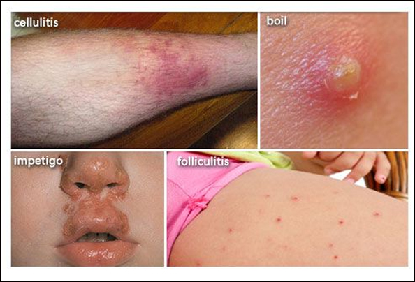 Skin and Soft Tissue Infection